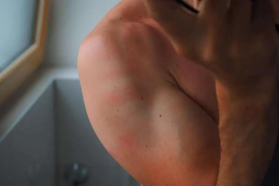 How to Survive a Hotel or Hostel with No Air Conditioning - Avoid Getting Sunburn